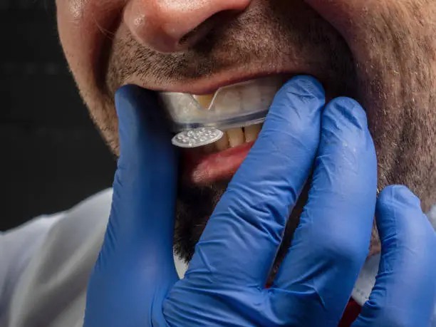 Athlete receiving a custom sports mouthguard fitting