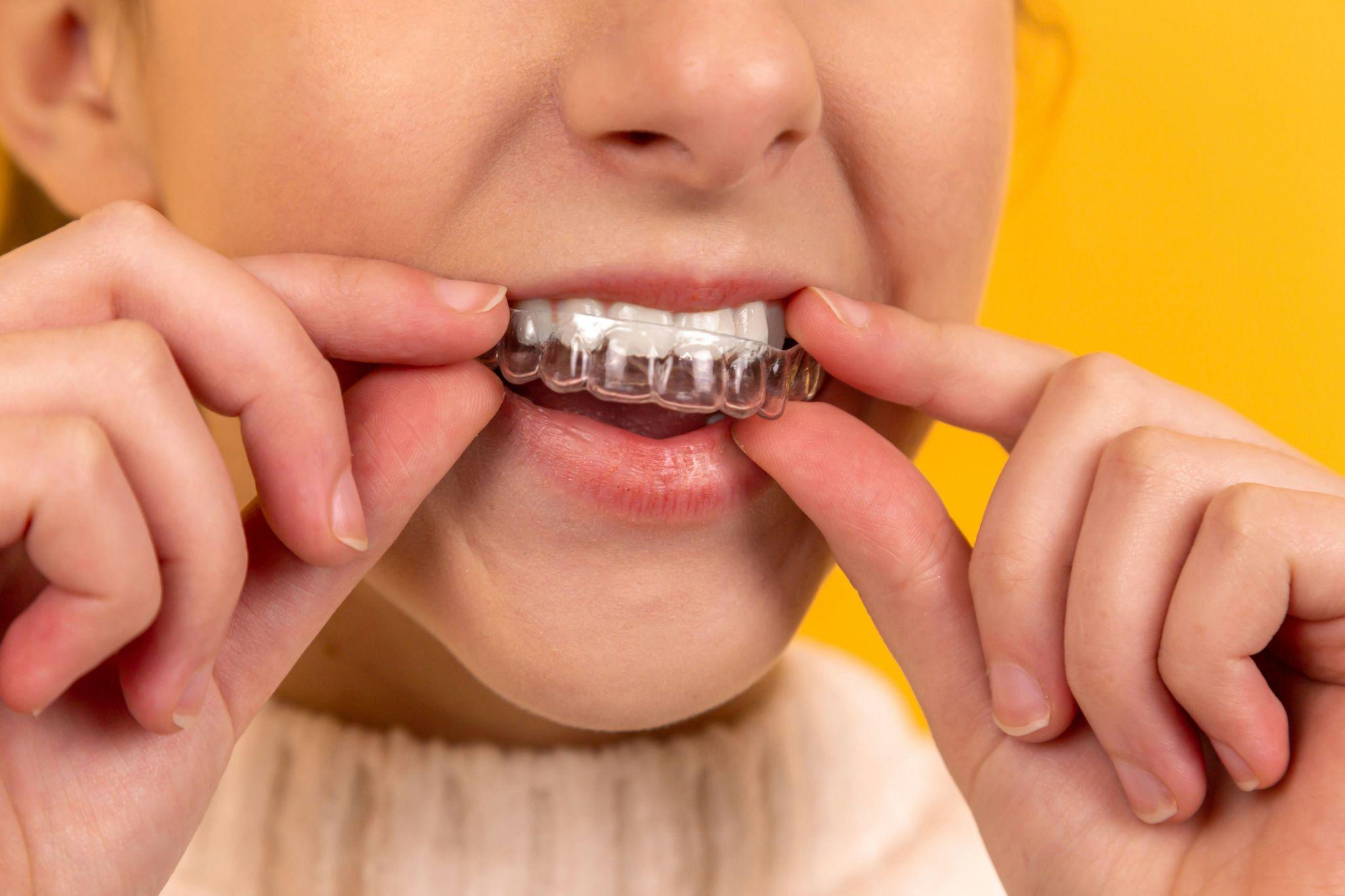 A person inserts a clear protective mouthguard for a secure fit, representing custom fit mouthguards in Fresno.