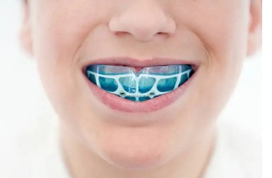 Custom sports mouthguards in Kingsburg with secure fit